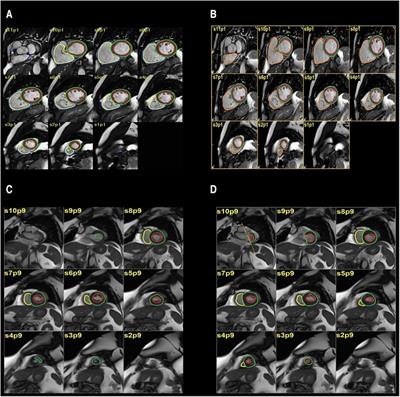 Clinical assessment of an AI tool for measuring biventricular parameters on cardiac MR